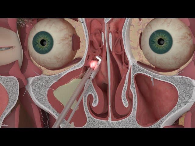 Chapter 3: Nasal and Sinus Problems and Solutions