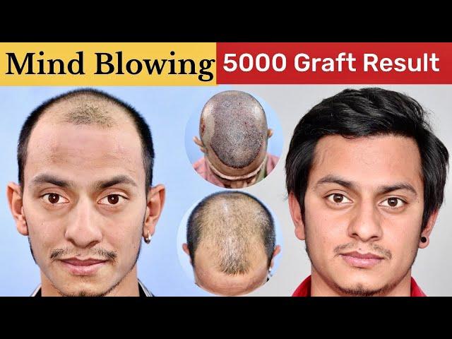 This is Unbelievable Hair Transplant Result | 30 Months Hair Transplant Result