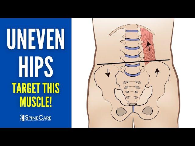 Quickly Fix Uneven Hips (by Releasing This Tight Muscle)