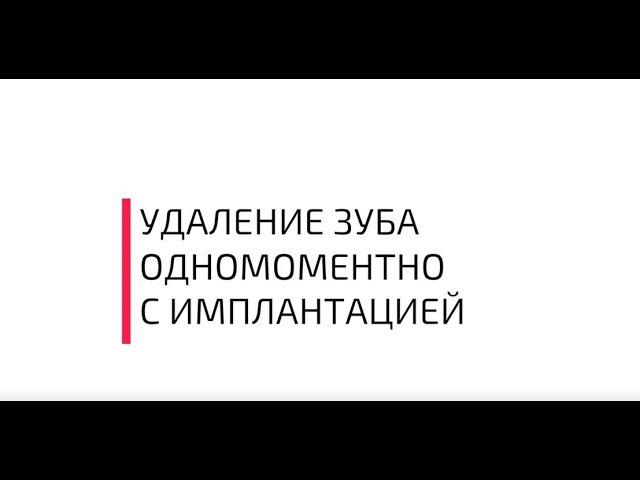 Удаление зуба одномоментно имплантацией