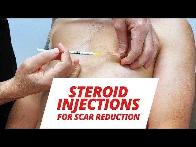 Steroid Injections After Gynecomastia Surgery (SCAR TISSUE REDUCTION)