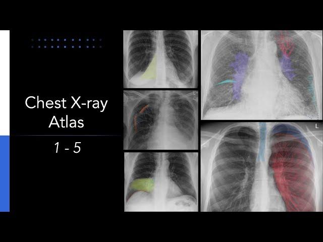 Chest X-ray Atlas: 5 Essential Chest X-rays for Students