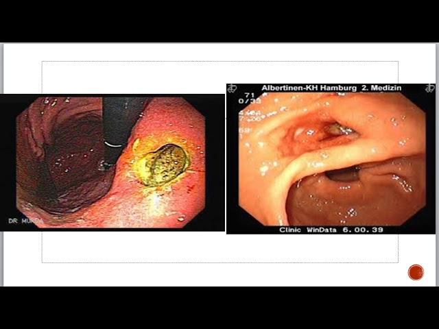 Лекция: Осложнения язвенной болезни желудка: перфорация и стеноз