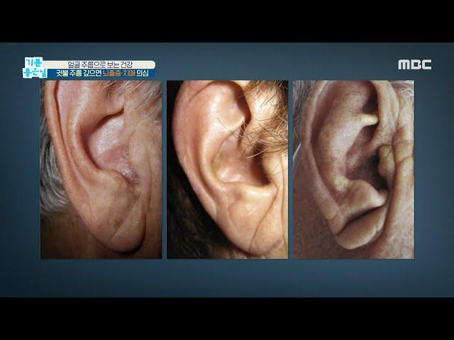 [HEALTHY] Deep earlobes, deep wrinkles, suspect stroke or dementia!, 기분 좋은 날 20200925