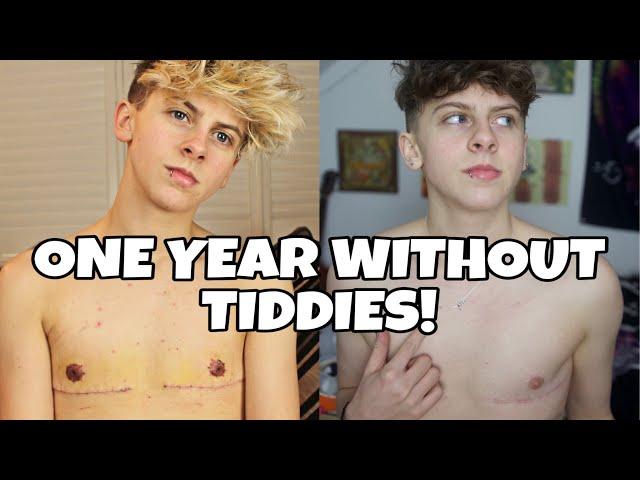 TOP SURGERY RESULTS ONE YEAR POST OP (FTM TRANSGENDER) | NOAHFINNCE