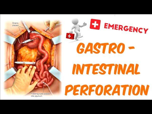 Gastrointestinal Perforation