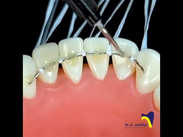 Fixed Retainer Procedure #dentist #orthodontist#Fixed_retainer#braces #retainer#retention#lingual