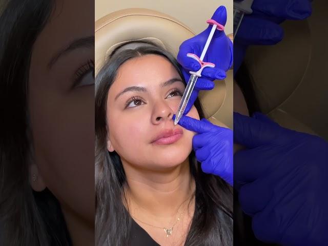 A glimpse into our lip filler process  #medicalaesthetics #lipfillers #lipfillerinjections