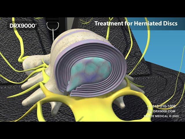 What is Spinal Decompression? DRX9000 for low back pain, sciatica and herniated disc. Avoid Surgery.