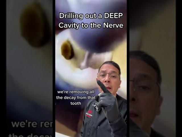 Removing Deep Cavity to Prepare for Root Canal | View Mobile Dental