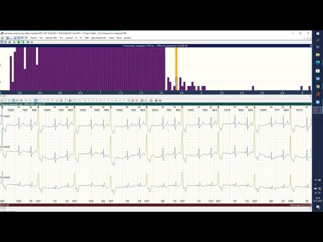 Практичний онлайн майстер-клас ECGpro Holter 28/01/2022