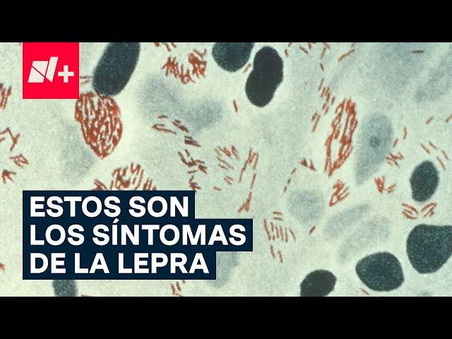 ¿Qué es y cuáles son los síntomas de la lepra? - N+