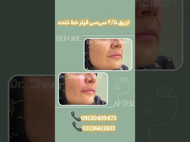 تزریق فیلر خط خنده باعث پرشدن این خط و در نتیجه جوانسازی صورت میشود#فیلر #زیبایی #پزشک #جوانسازی