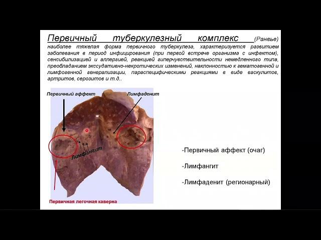 Патологоанатомическая диагностика основных форм туберкулеза