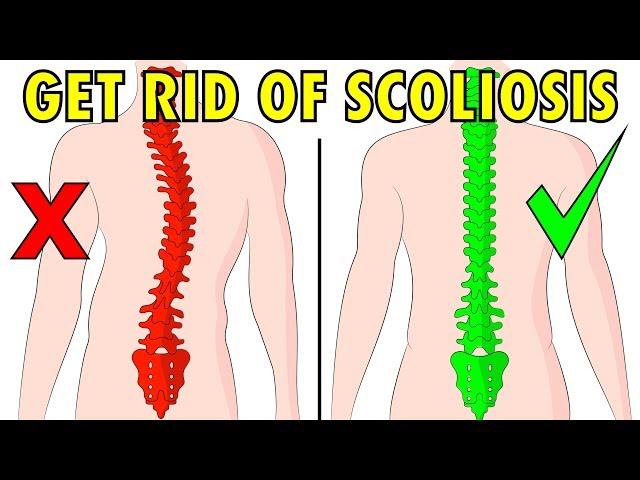 How to fix scoliosis naturally in 4 minutes a day