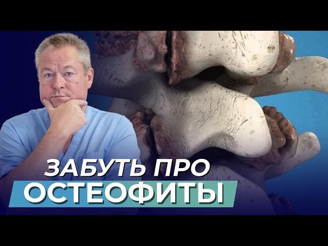 Остеофиты: КОСТНЫЕ разрастания и их влияние на здоровье. Что делать