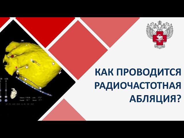 Абляция предсердия с использованием систем трехмерного навигационного картирования