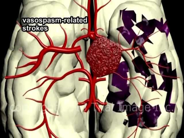 Circle of Willis Anatomy and Brain Aneurysms video by Dr. Cal Shipley, M.D.