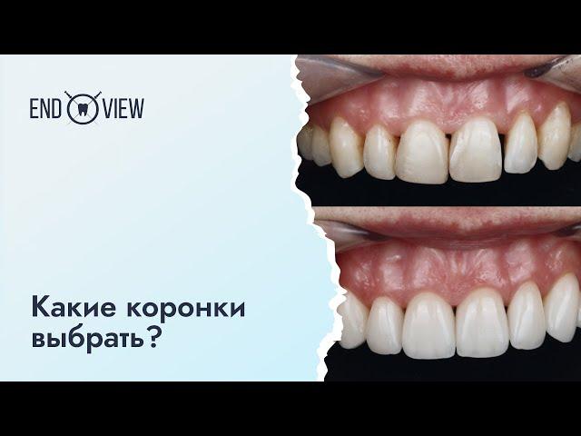 Коронки на передние зубы: какие лучше?