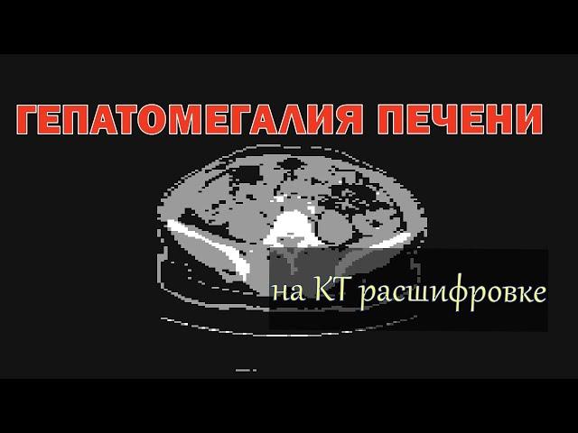 ГЕПАТОМЕГАЛИЯ и диффузные изменения печени на расшифровке КТ брюшной полости