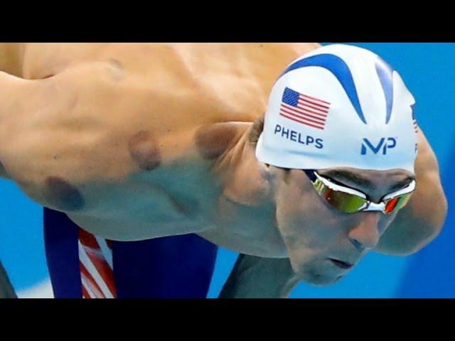 Why Olympians are doing the "cupping" treatment