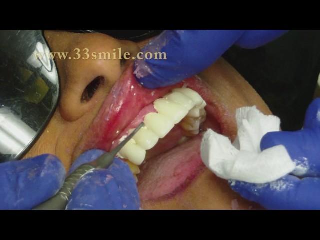 Dental Crowns and Bridges Procedure at Cosmetic Dental Associates in San Antonio, TX