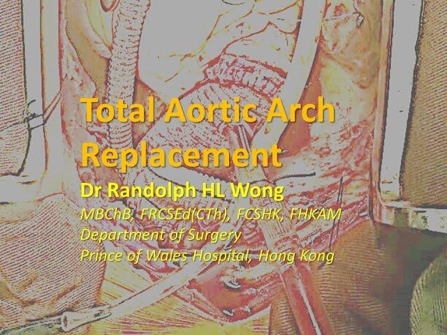 Total Aortic Arch Replacement, Dr Randolph HL Wong ,黃鴻亮醫生