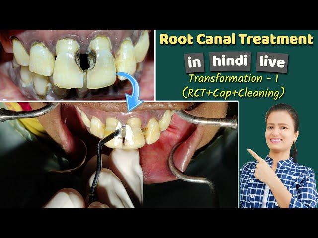 root canal treatment