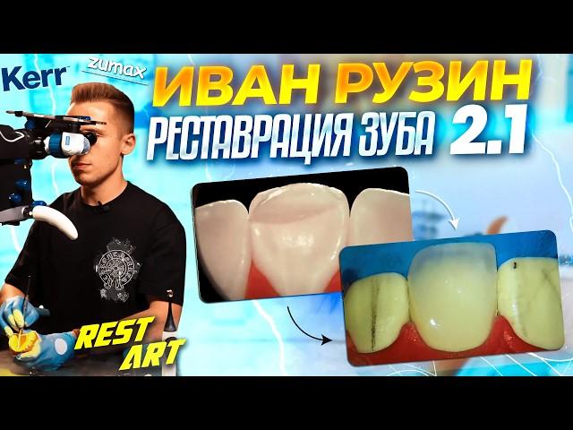 Реставрация зуба 2.1 - Иван Рузин | RestART