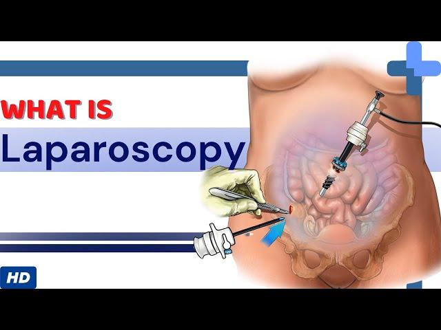 What Is Laparoscopy?