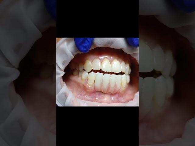 HIPC bridge for lower 4 incisors and 3 basal implants fixing video! ##shorts