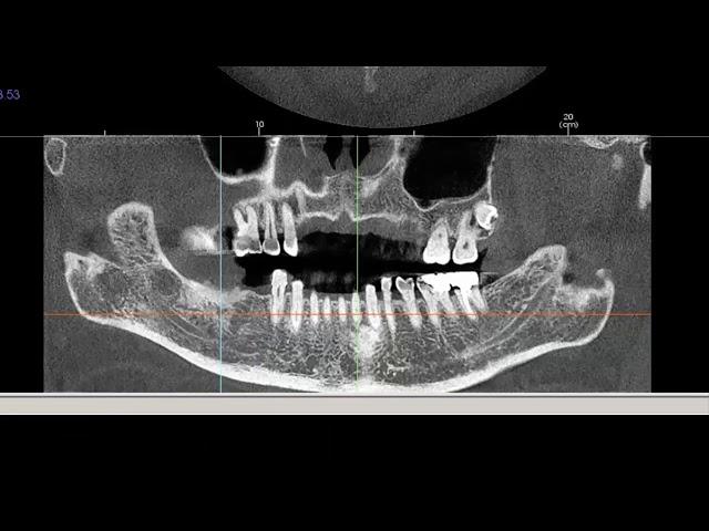 Tx STUDIO™: Implant Planning and Placement