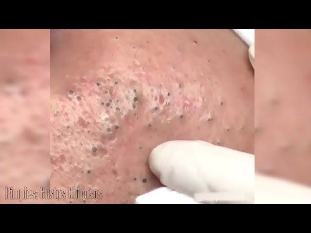 Extracción de enormes y llamativos puntos negros | Rostro repleto de blackhead