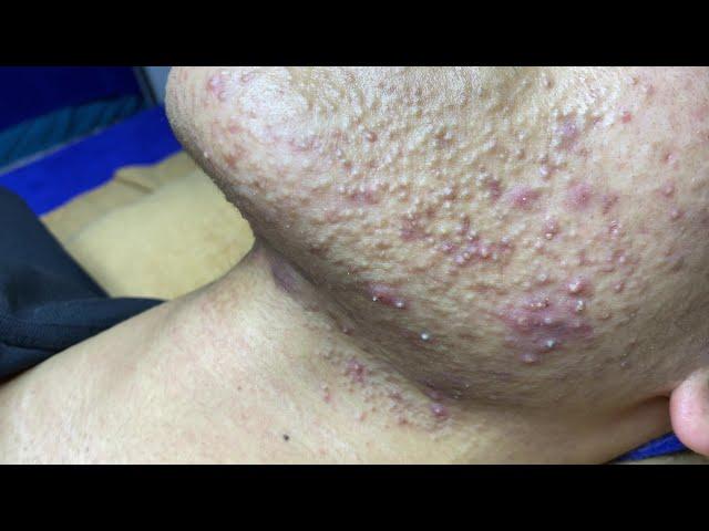 Best Pimple Popping P1 | Mụn Dậy Thì Siêu Hấp Dẫn P1 - SacDepSpa#181