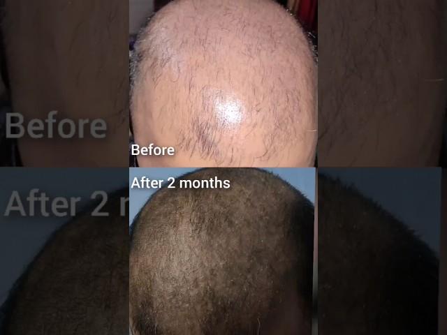 Traya Review After 2 months !! shedding phase  #traya #hairloss #hairlosstreatment