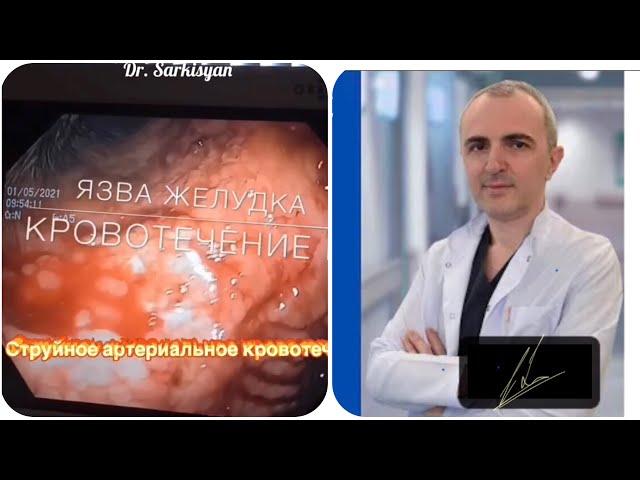 Остановка кровотечения из желудка. Язва желудка. #shorts #trending #viral #youtubeshorts #freefire