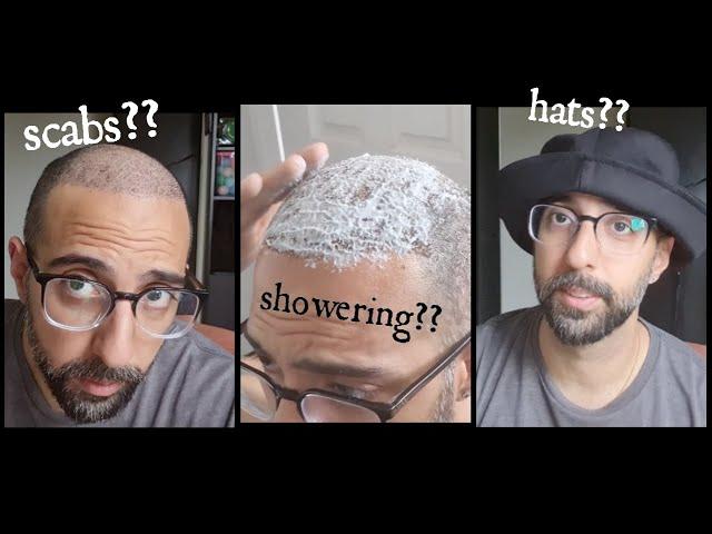 How to wash your hair and remove scabs after a hair transplant / When can you wear hats?