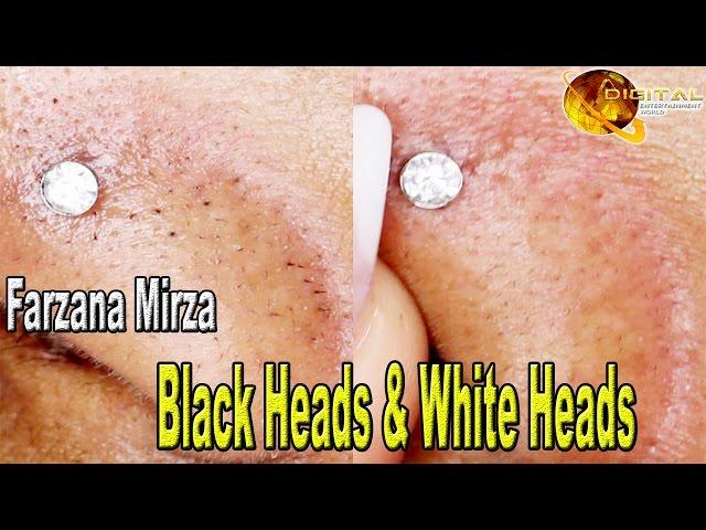 “Black Heads & White Heads” | Homemade Beauty Tips | Fashion Zone | HD Video