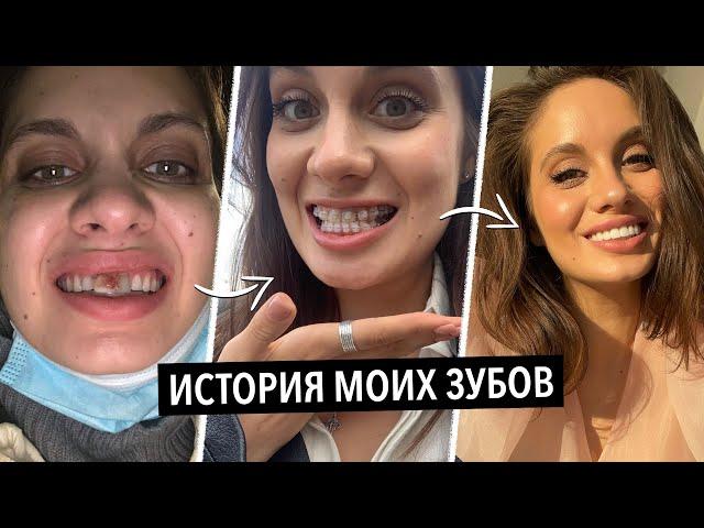 МОЯ ИСТОРИЯ ЗУБОВ | ВИНИРЫ, БРЕКЕТЫ, КОРОНКИ, УДАЛЕНИЕ