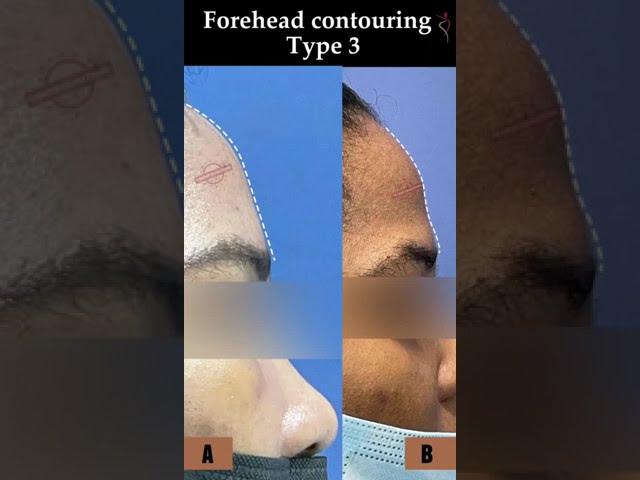 Forehead Contouring Type 3 | #shorts | #youtubeshorts