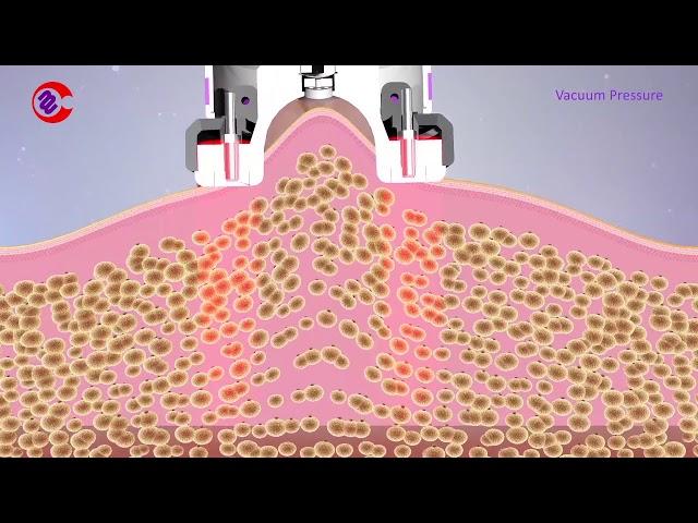 How Vacuum RF Fat Reduction Skin Tightening Treatment Work|Slimming Lymphatic Drainage Machine