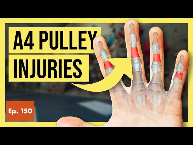 A4 Pulley Injuries in Rock Climbers (Causes, Risks, & Full Recovery)