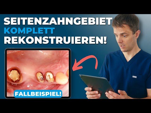 Rekonstruktion einer Seitenzahnreihe mit Implantat und Sinuslift | Fallbeispiel