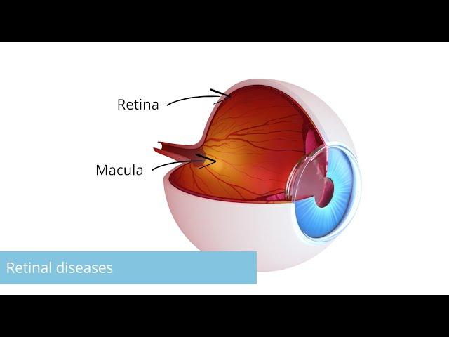 Retinal diseases: Causes, symptoms, diagnosis & treatment. Essentials in 3 minutes. Eye surgery.