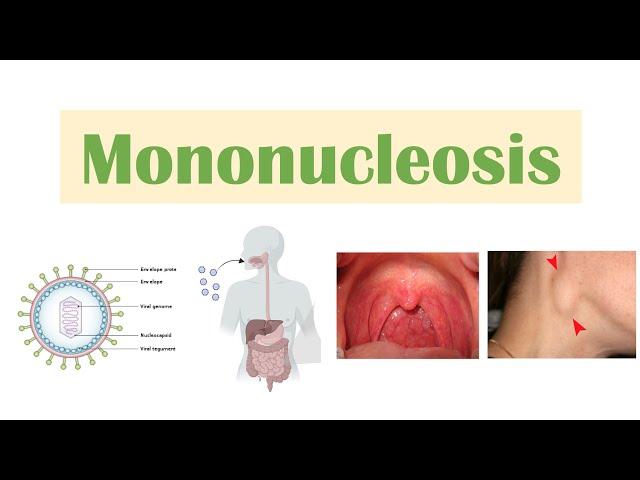 Infectious Mononucleosis (Mono) | Epstein-Barr Virus, Transmission, Symptoms, Diagnosis, Treatment