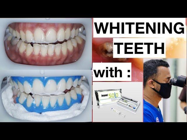 Dental Whitening Procedure Natural Bright Smile with Beyond Kit | General Dentist Griya RR