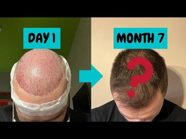 FUE Hair Transplant 7 month update | SMILE Hair Clinic, Istanbul