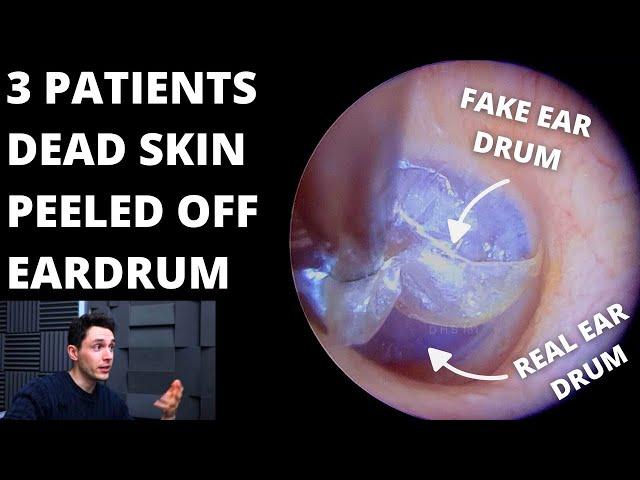 3 Patients With Dead Skin Trapping Eardrum (LIVE AUDIO LAST CASE)