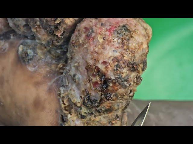 Philip Butabila -  jiggers, dead skin Day Two #3 ---long videos @riseupsociety.net & @ruskenya.org