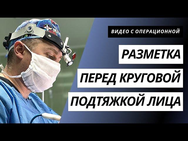 РАЗМЕТКА ПЕРЕД КРУГОВОЙ ПОДТЯЖКОЙ ЛИЦА | КОМПЛЕКСНОЕ ОМОЛОЖЕНИЕ ЛИЦА | ПОДТЯЖКА ЛИЦА КИЕВ